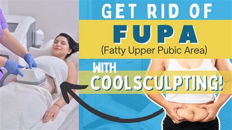 FUPA: Fatty Upper Pubic Areas